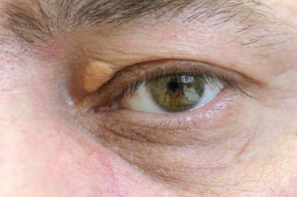 Ксантелазма век Ксантелазма век