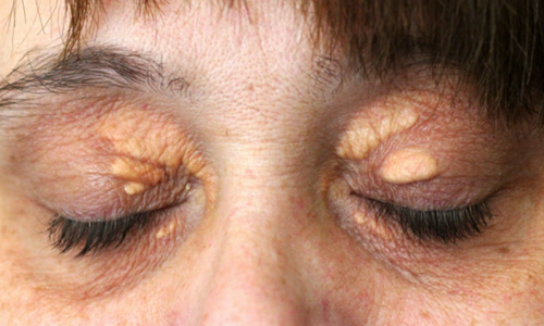 Ксантелазма век Ксантелазма век