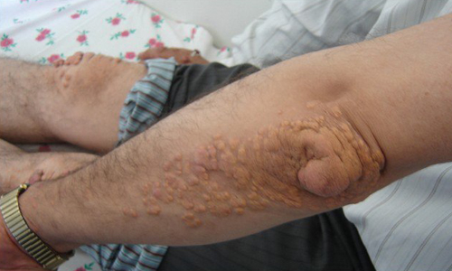 Ксантомы на локтях и коленях Ксантомы на локтях и коленях