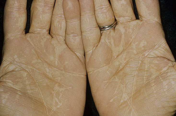 Ладонные ксантомы Ладонные ксантомы