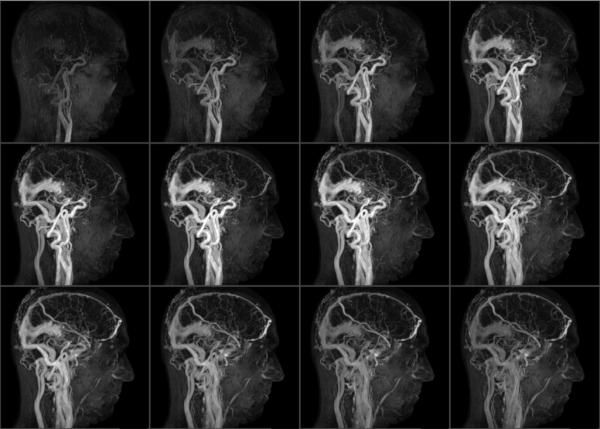 МР-артериография головного мозга МР-артериография головного мозга
