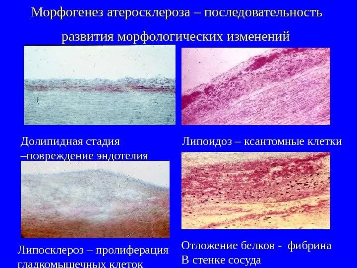 Морфогенез атеросклероза Морфогенез атеросклероза