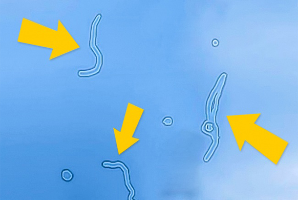 Мушки перед глазами Мушки перед глазами