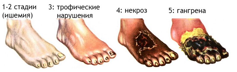 Некроз тканей Некроз тканей