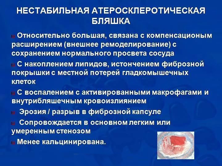 Нестабильная бляшка Нестабильная бляшка