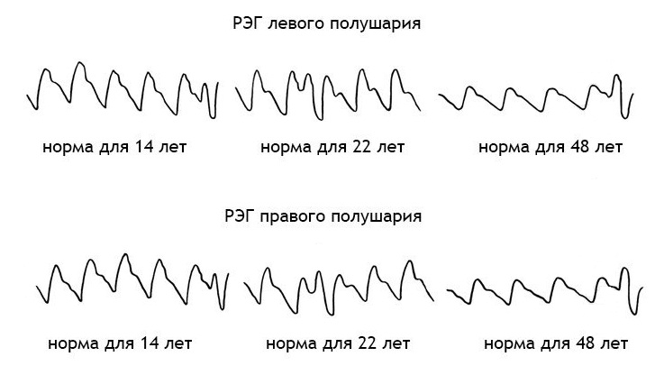 Нормы реоэнцефалографии Нормы реоэнцефалографии