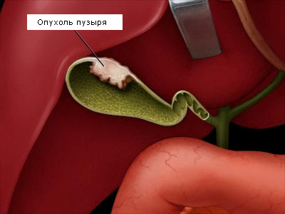 Опухоль в пузыре Опухоль в пузыре