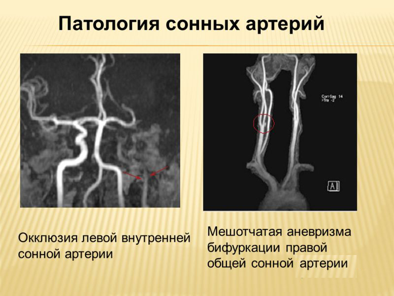 Патологии сонных артерий Патологии сонных артерий