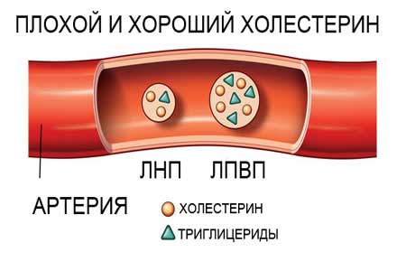 Плохой и хороший холестерин Плохой и хороший холестерин
