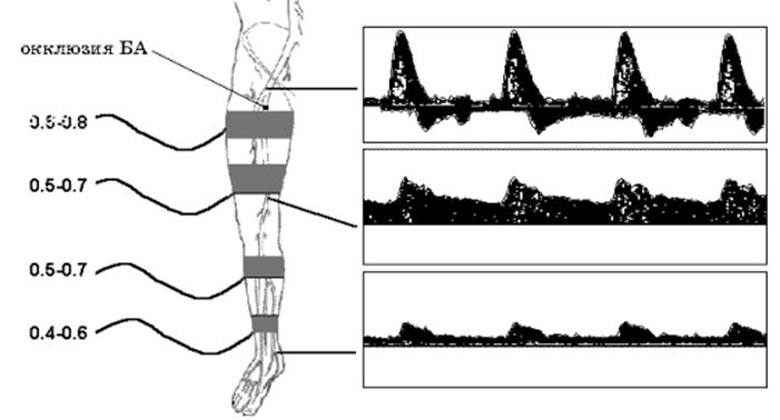 Показатели при допплерографии Показатели при допплерографии