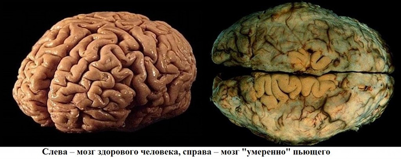 Последствия алкоголизма для мозга Последствия алкоголизма для мозга