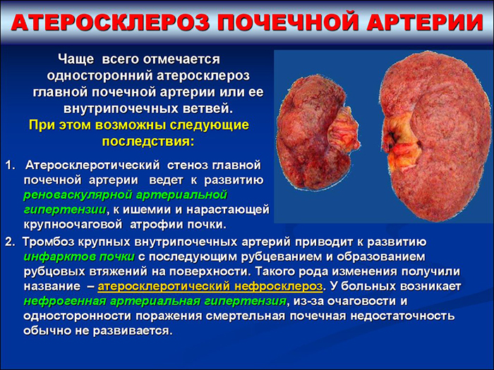 Последствия атеросклероза почечных артерий Последствия атеросклероза почечных артерий