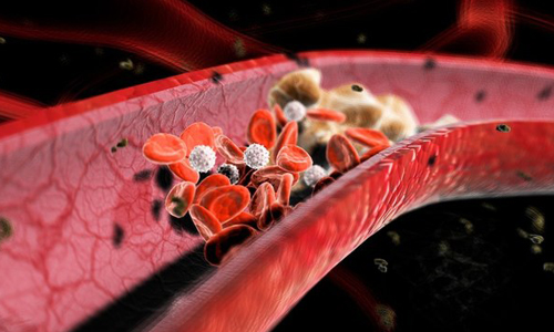 Проблема атеросклероза сосудов Проблема атеросклероза сосудов