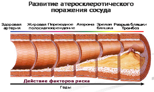 Развитие атеросклероза Развитие атеросклероза