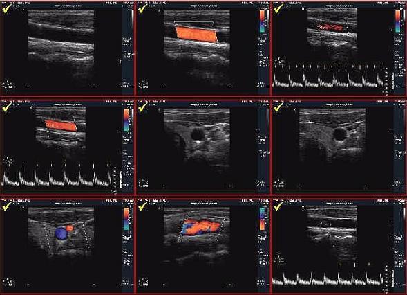 Результаты УЗГД Результаты УЗГД