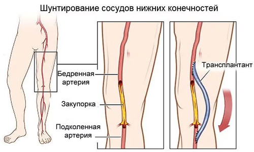 Шунтирование сосудов нижних конечностей Шунтирование сосудов нижних конечностей