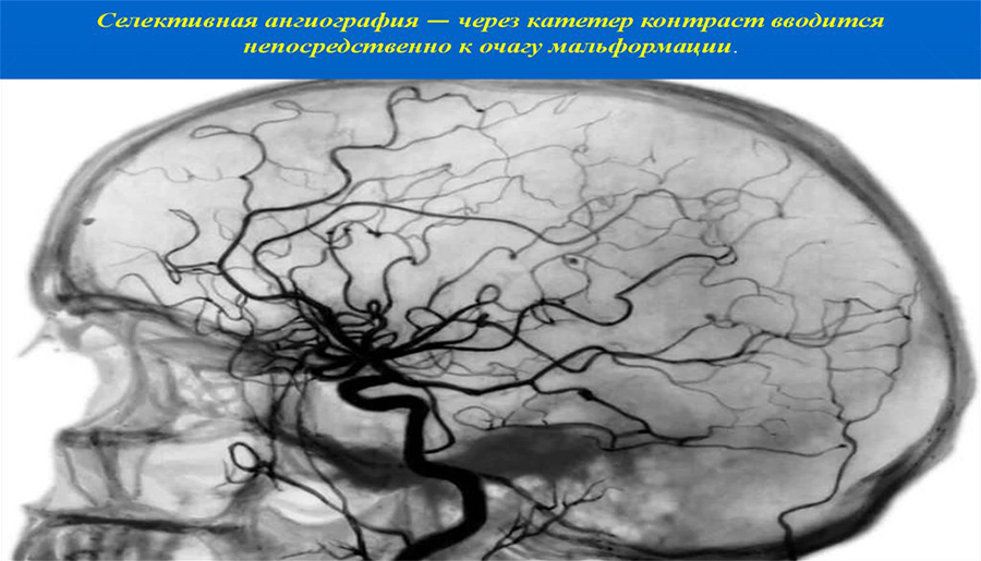 Селективная ангиография Селективная ангиография