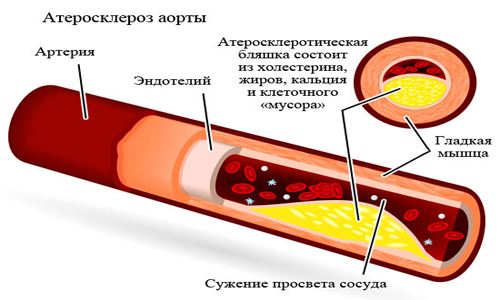 Схема атеросклероза аорты Схема атеросклероза аорты