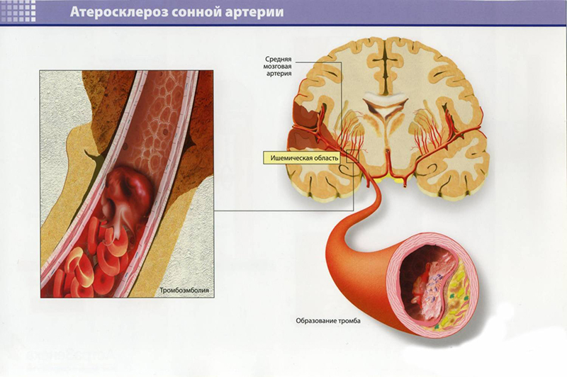 Схема атеросклероза сонной артерий Схема атеросклероза сонной артерий