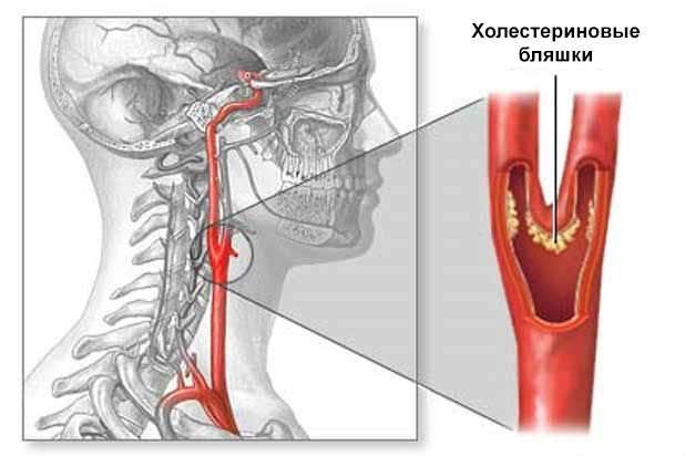 Схема атеросклероза сосудов шеи Схема атеросклероза сосудов шеи