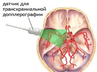 Схема допплерографии сосудов головы Схема допплерографии сосудов головы