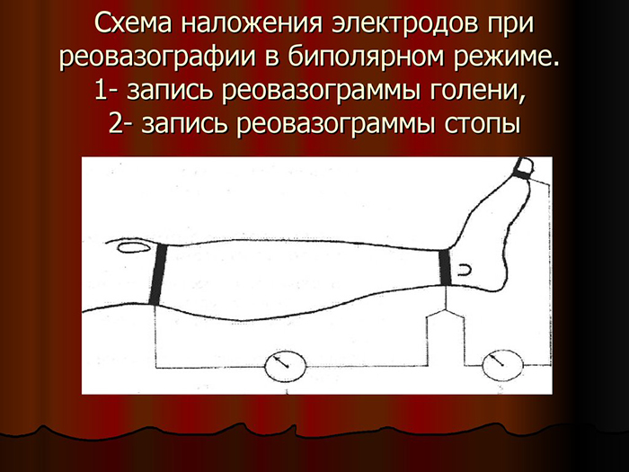 Схема наложения электродов Схема наложения электродов