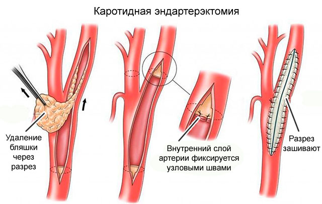 Схема проведения операции Схема проведения операции