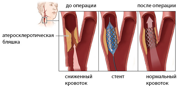 Схема стенирования Схема стенирования