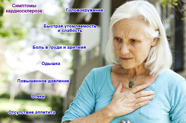 Симптомы кардиосклероза Симптомы кардиосклероза