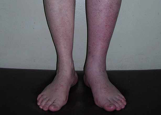 Синюшность нижних конечностей Синюшность нижних конечностей