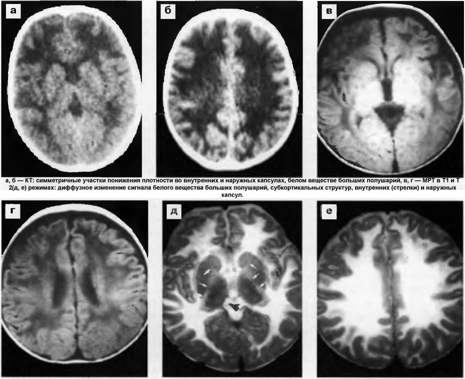Спонгиозная дегенерация белого вещества Спонгиозная дегенерация белого вещества