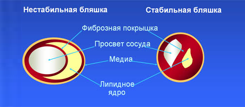 Стабильная и нестабильная бляшки Стабильная и нестабильная бляшки