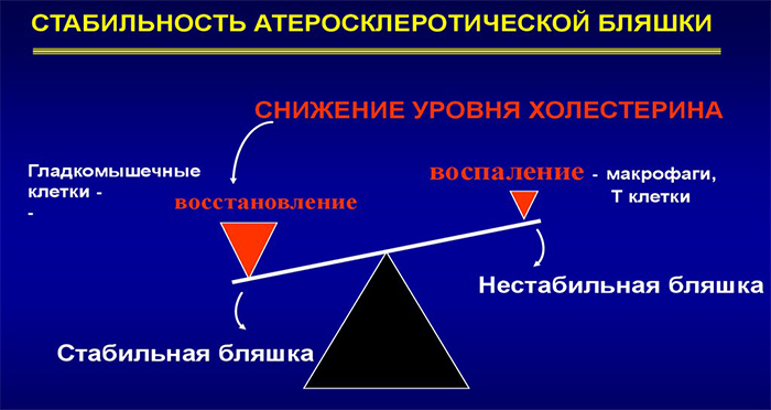 Стабильность атеросклеротической бляшки Стабильность атеросклеротической бляшки