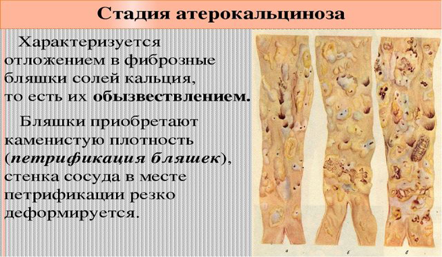 Стадия атерокальциноза Стадия атерокальциноза