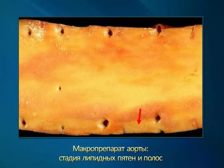 Стадия липидных пятен и полос Стадия липидных пятен и полос
