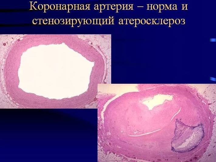 Стенозирующий атеросклероз коронарных артерий Стенозирующий атеросклероз коронарных артерий