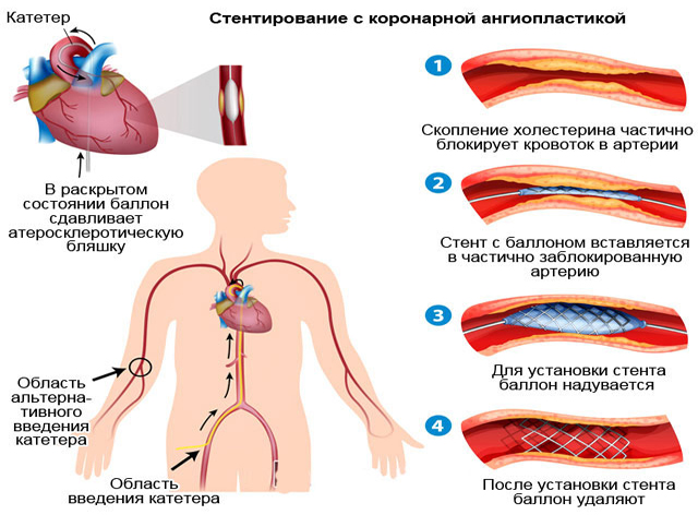 Стентирование с коронарной ангиопластикой Стентирование с коронарной ангиопластикой