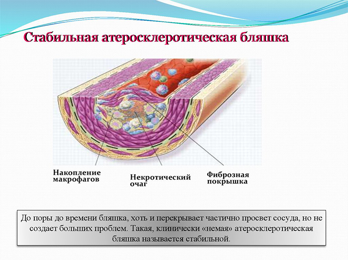 Строение стабильной бляшки Строение стабильной бляшки