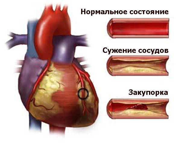 Сужение и закупорка сосудов Сужение и закупорка сосудов