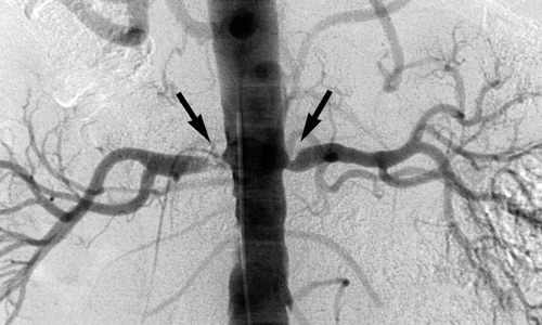 Сужение почечных артерий Сужение почечных артерий