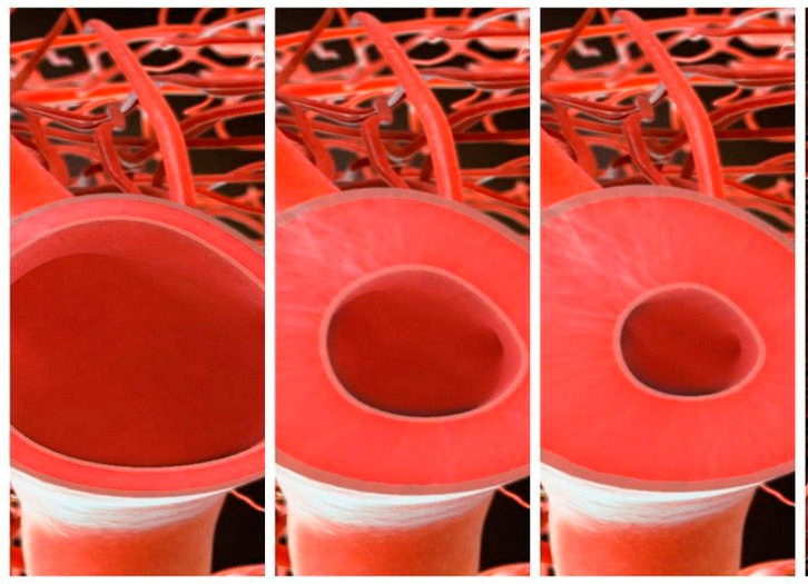 Сужение внутреннего просвета сосудов Сужение внутреннего просвета сосудов