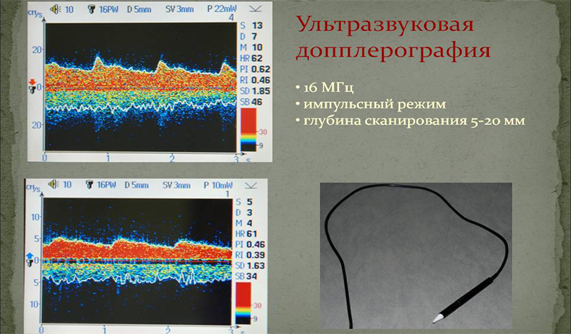 Ультразвуковая допплерография Ультразвуковая допплерография