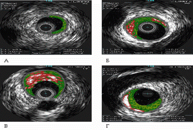 Ультразвуковое внутрисосудистое исследование Ультразвуковое внутрисосудистое исследование