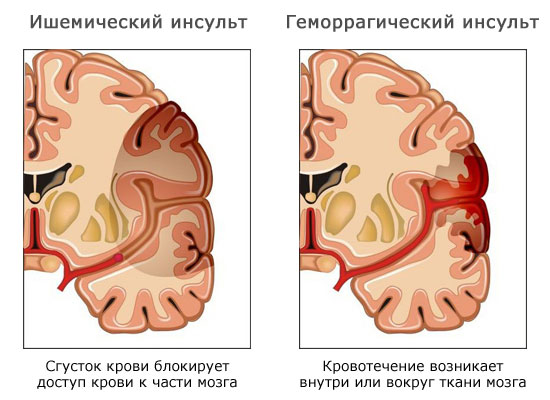 Виды инсульта Виды инсульта