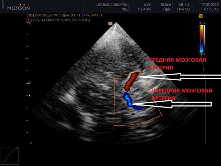 Визуализация сосудов на снимке Визуализация сосудов на снимке