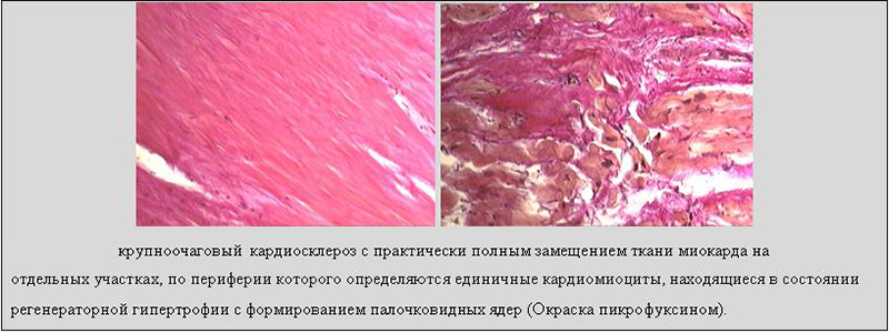 Замещение ткани при кардиосклерозе Замещение ткани при кардиосклерозе