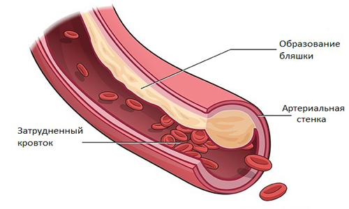 Затруднение кровотока Затруднение кровотока