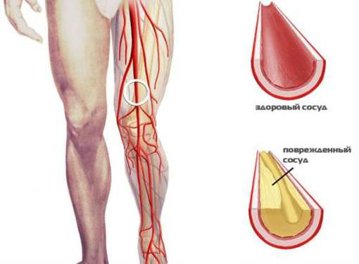 Здоровый и поврежденный сосуд Здоровый и поврежденный сосуд